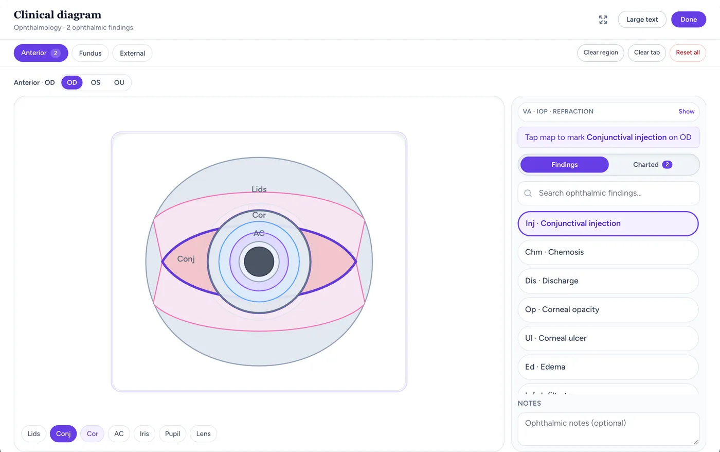 Medabha ophthalmology anterior segment chart with corneal opacity and conjunctival injection marked